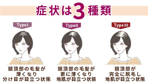 女性の薄毛（FAGA）の症状は3種類に分けられる