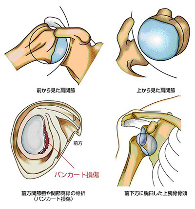 肩関節脱臼 反復性肩関節脱臼 医療法人順和会 京都下鴨病院