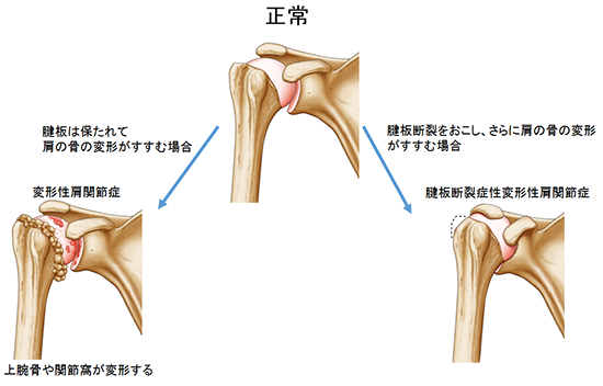 変形性肩関節症｜医療法人社団順和会 京都下鴨病院