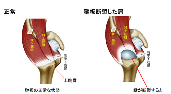 断裂 肩 症状 板 腱 肩の痛み『腱板損傷・腱板断裂』の原因・症状・リハビリ治療について解説をします。