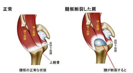 損傷 リハビリ 板 腱