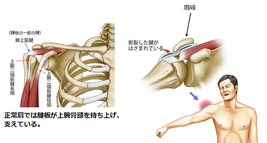 腱 板 断裂