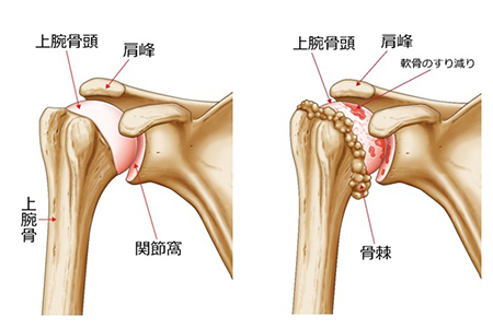 骨連結用の医療器具だと思います